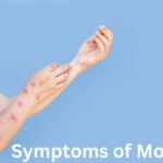 Monkeypox: Spread, Symptoms, Prevention