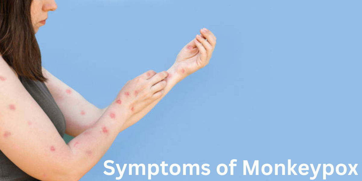 Monkeypox: Spread, Symptoms, Prevention